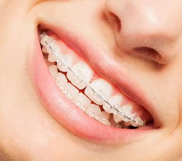 Cherry Hill Clear Braces
