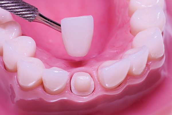 The Benefits Of Dental Crowns For Your Oral Health