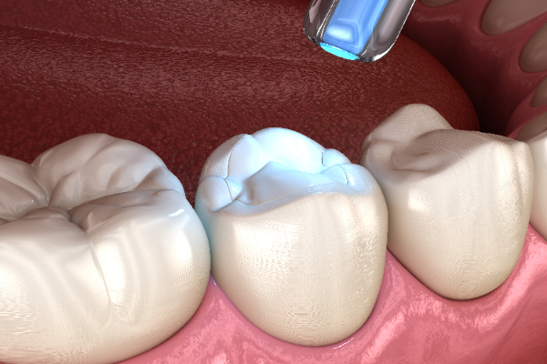 Why You Should Get Cavities Treated With Dental Fillings