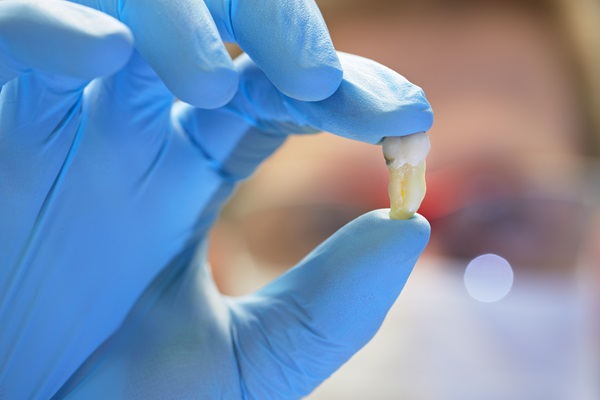 What To Know When Getting A Tooth Extraction